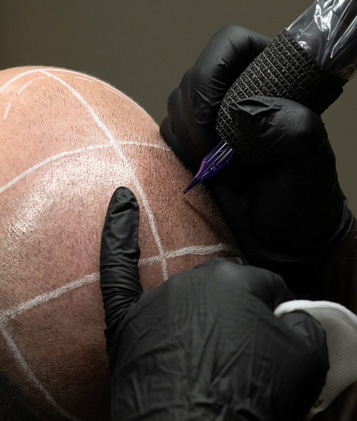 MaleHairLoss3 MaleHairLoss3