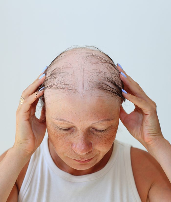 Scalp Micropigmentation For Hormonal Hair Loss
